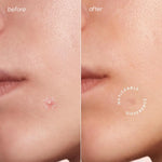 Invisible Pimple & Acne Patches - Image 2