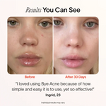 Bye Acne: 3-Minute Pimple Spot Treatment - Image 6