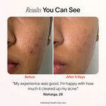 Bye Acne: 3-Minute Pimple Spot Treatment - Image 5